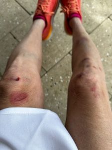 Bruised legs